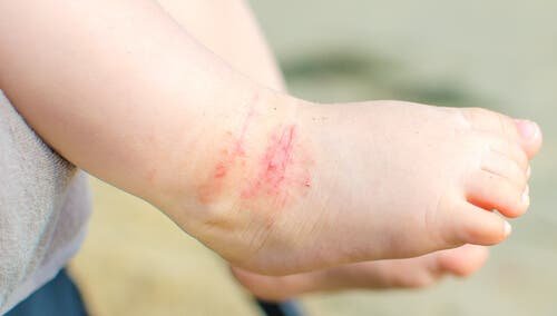 La dermatite chez un bébé