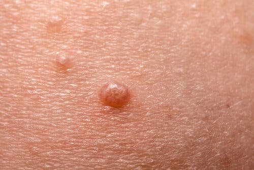 Un molluscum sur la peau