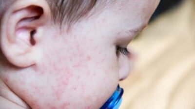 Irritations cutanées chez les bébés : guide complet des symptômes et traitements