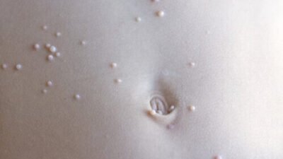 Comprendre le molluscum contagiosum chez les enfants : symptômes, traitements et prévention