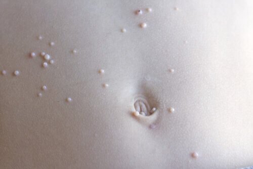 Comprendre le molluscum contagiosum chez les enfants : symptômes, traitements et prévention
